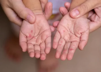 Picture of measles on hands
