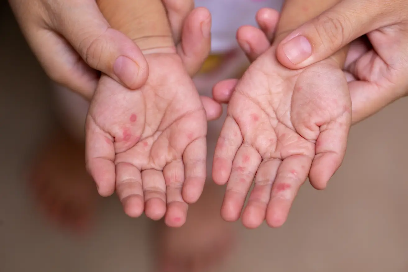 Picture of measles on hands